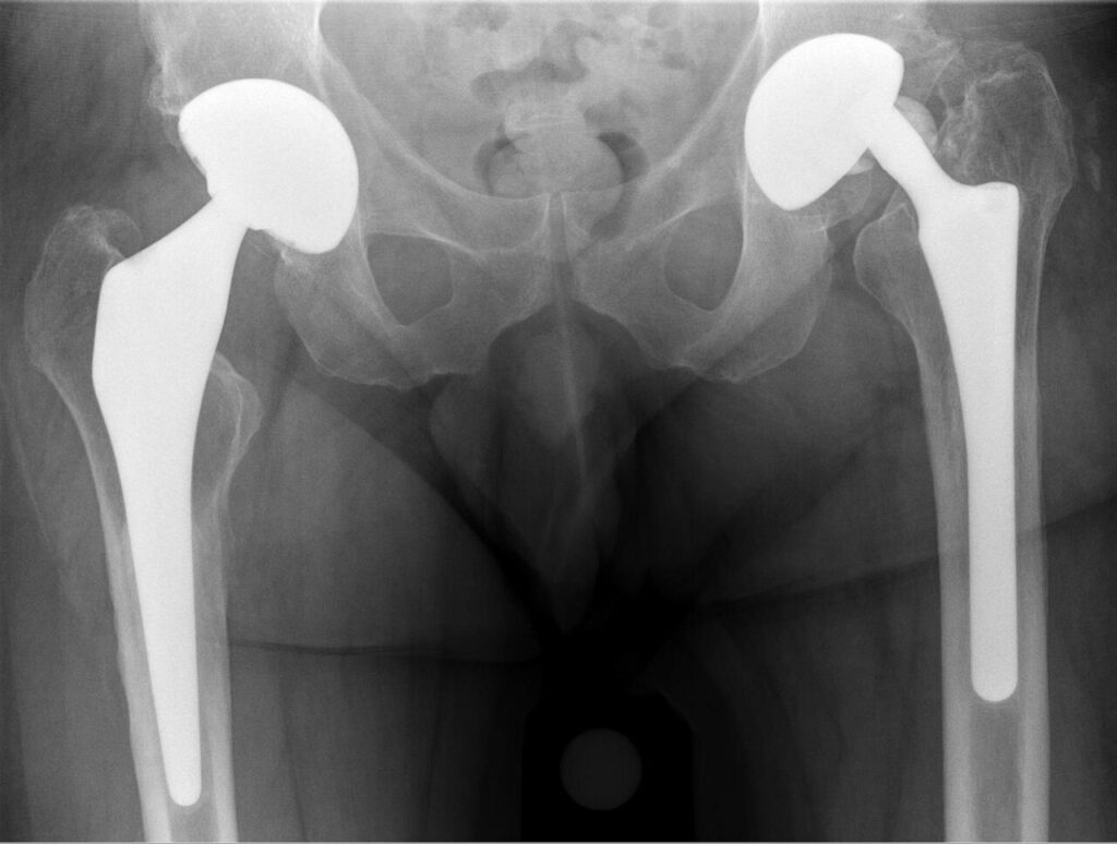Arthroplasty iSAWE 15, AP radiograph of the pelvis