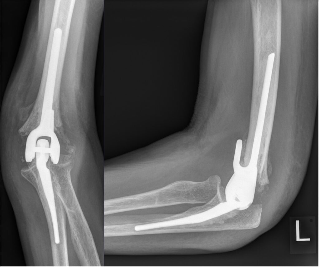Arthroplasty iSAWE 16, AP and lateral radiographs of the elbow