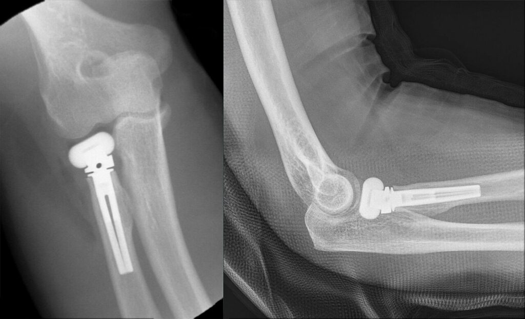 Arthroplasty iSAWE 17, radiographs of the elbow