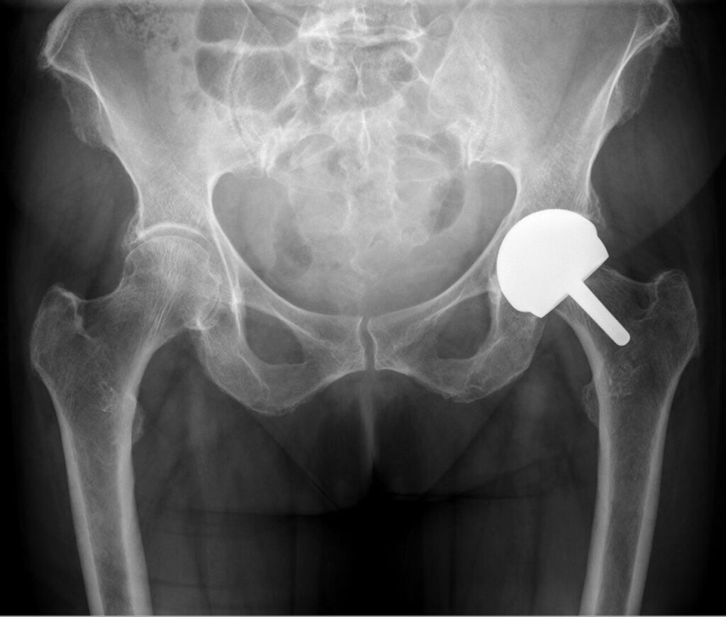 Arthroplasty iSAWE 18, AP radiograph of the pelvis