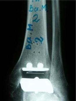 Arthroplasty iSAWE 19, AP radiograph of the ankle