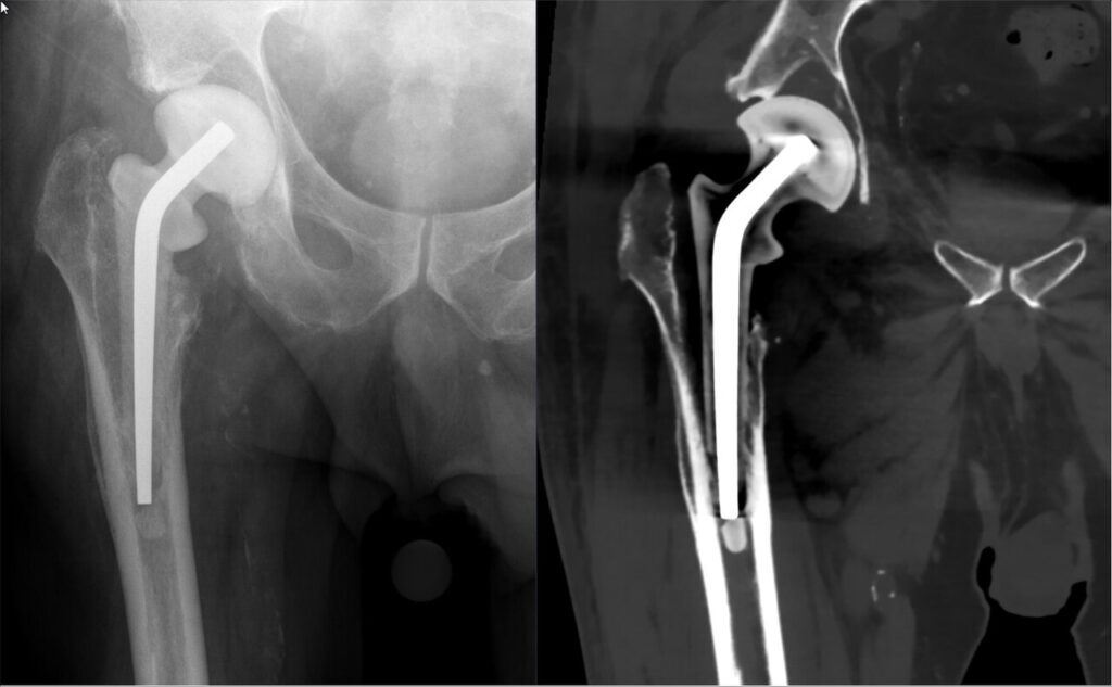 Arthroplasty iSAWE 20, AP radiograph and coronal CT of the hip