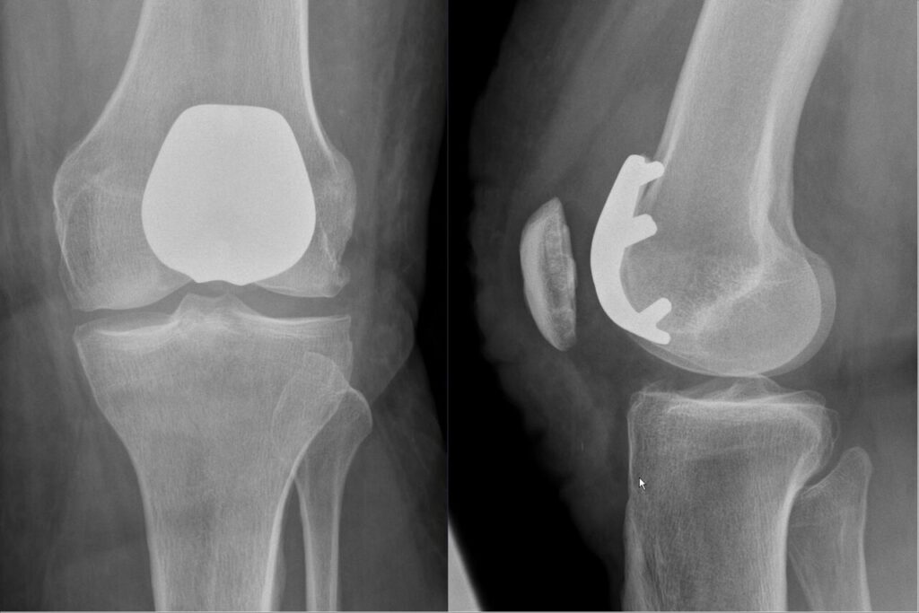 Arthroplasty iSAWE 5, AP and lateral radiographs of the knee