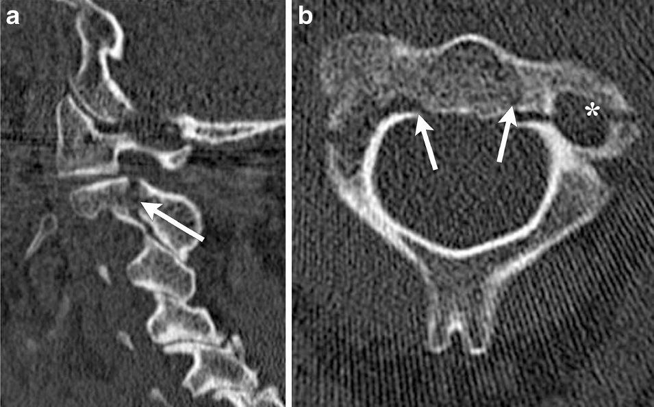 Spine iSAWE 17, sagittal and axial CT of the upper cervical spine