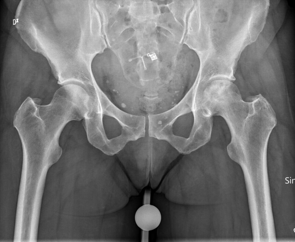 AVN, pelvic radiograph showing idiopathic avascular necrosis of the femoral head