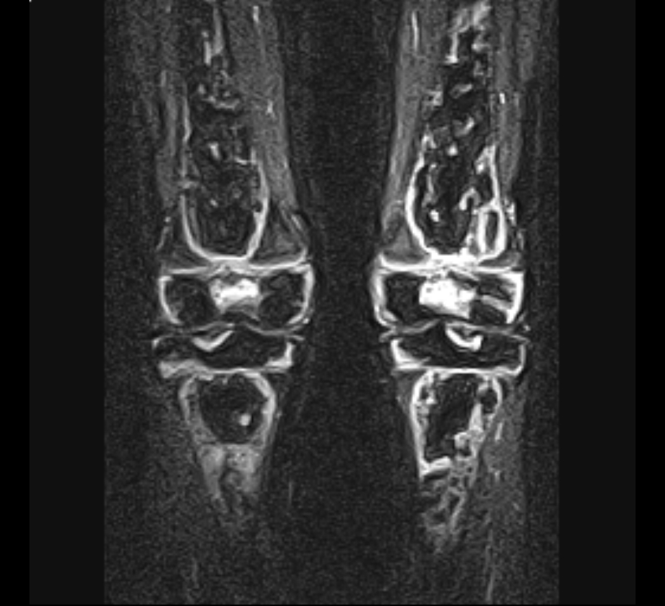 Knee iSAWE 13, coronal STIR MRI of both knees