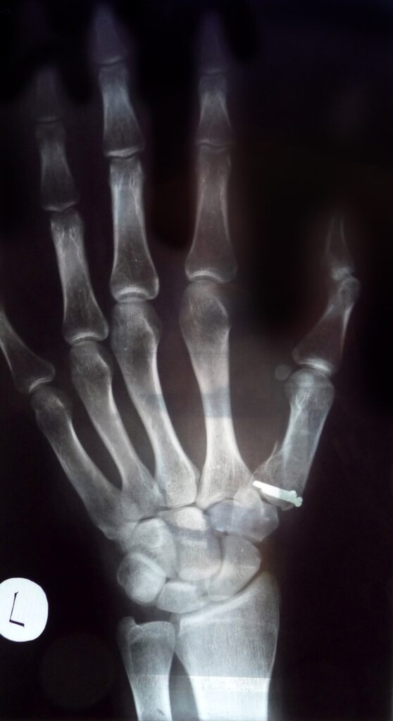 Hand iSAWE 5, radiograph of the thumb