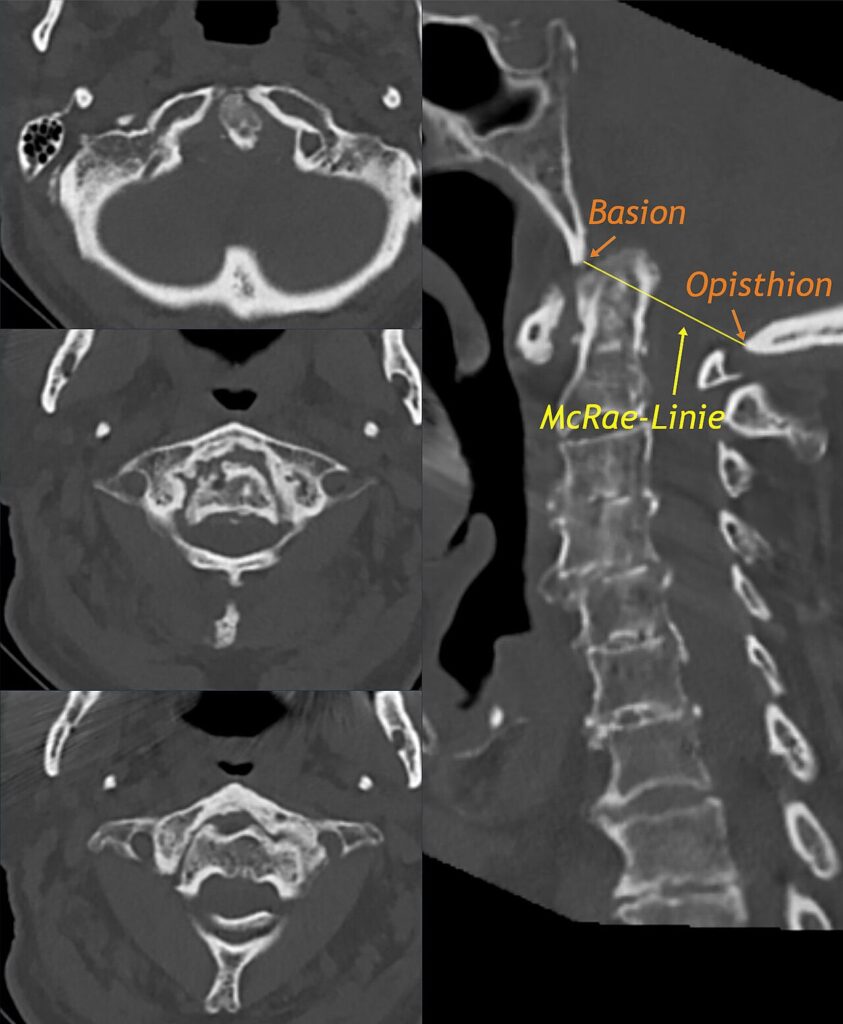 Spine iSAWE 18, CT of the craniocervical junction