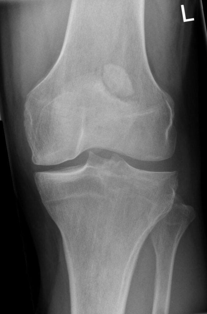 Knee iSAWE 20, AP radiograph of the knee