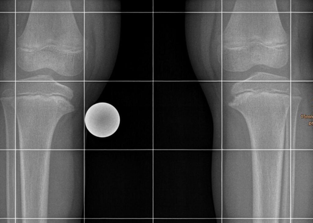 Radiograph of both knees