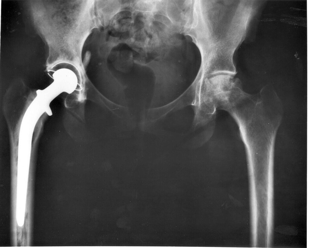 Arthroplasty iSAWE 4, AP radiograph of the pelvis