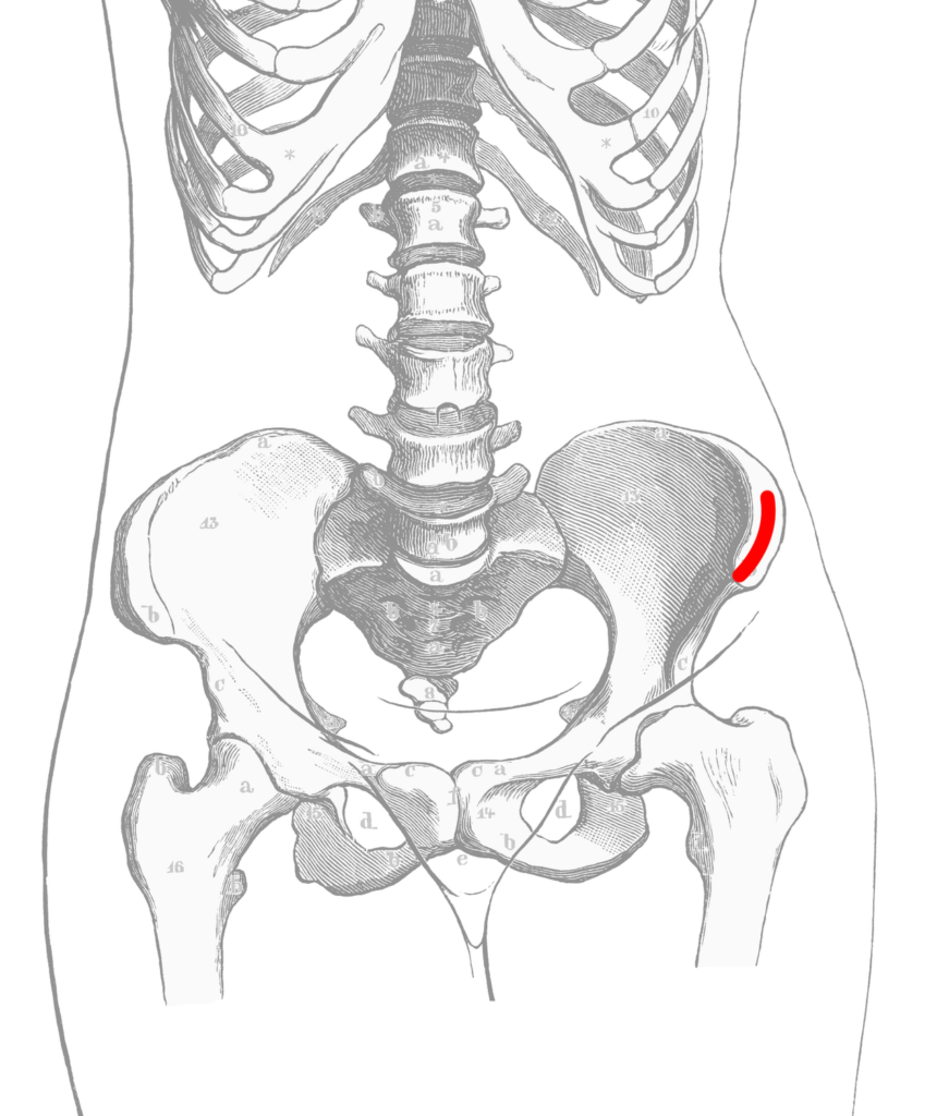 Bone Graft, location of an anterior iliac crest bone graft