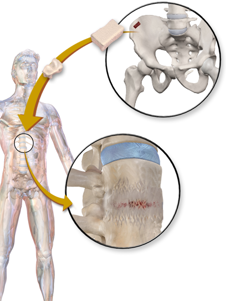 Bone Grafts and Substitutes, demineralised bone matrix used as a bone graft substitute