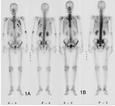 Bone Scan, technetium 99m hmdp bone scintigraphy
