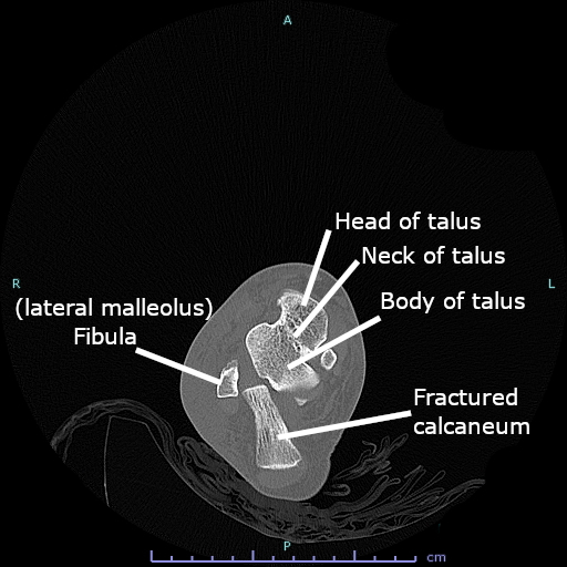 Calcaneal Fractures, ct of a calcaneal fracture
