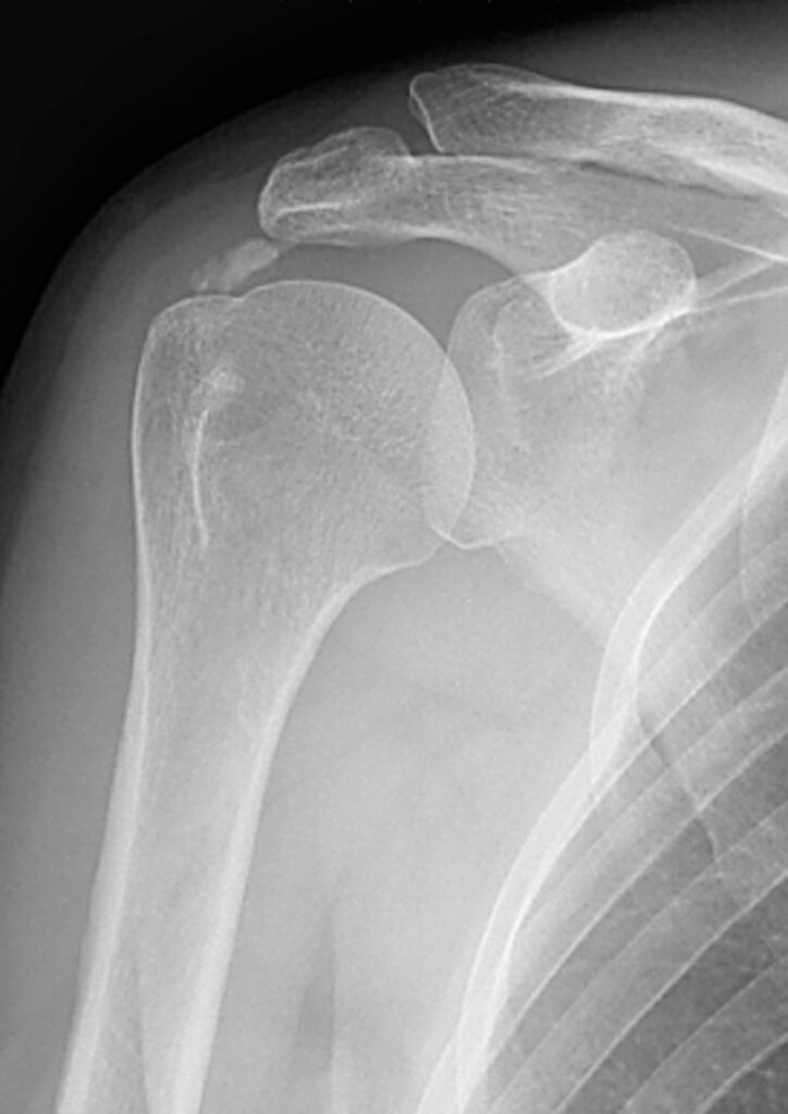 Shoulder Elbow iSAWE 11, ap radiograph of the shoulder