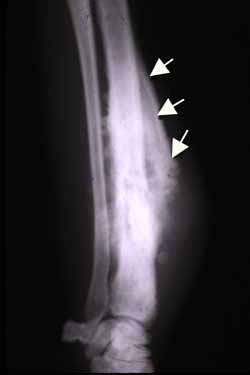 Causes of New Periosteal Bone Formation, radiograph showing a codman triangle of periosteal new bone