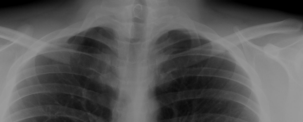 Cervical Rib (Thoracic Outlet Syndrome), chest radiograph showing a cervical rib