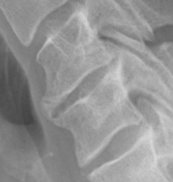 Cervical Spondylosis, radiograph of cervical spondylosis