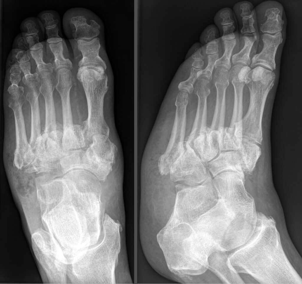 Charcot Arthropathy, radiograph of charcot arthropathy of the foot