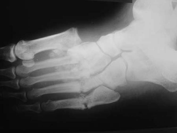 Charcot Arthropathy of the Shoulder, radiograph of charcot arthropathy of the foot
