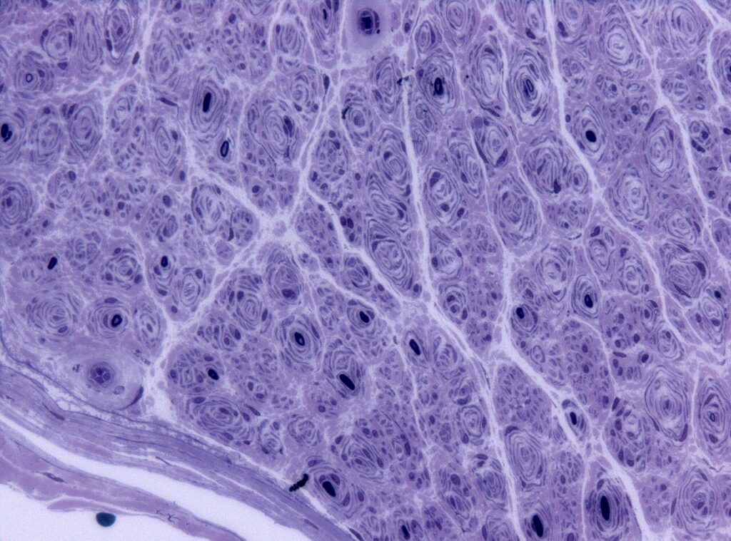 Charcot-Marie-Tooth Disease, onion bulb formation in a nerve biopsy from hereditary motor and sensory neuropathy