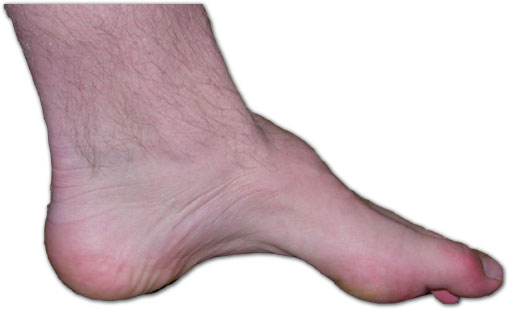 Charcot-Marie-Tooth Disease, cavus foot in charcot-marie-tooth disease