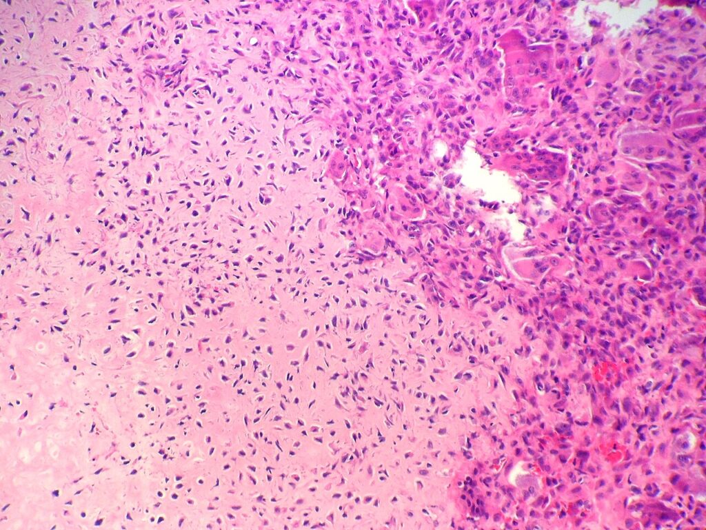 Chondroblastoma, histology of chondroblastoma with secondary aneurysmal bone cyst change