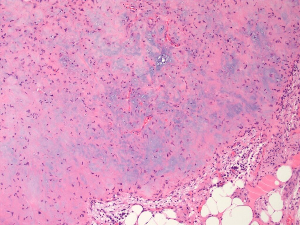 Chondromyxoid Fibroma, histology of chondromyxoid fibroma