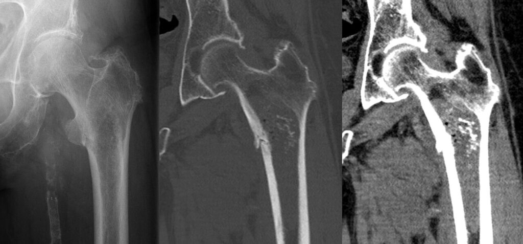 Tumour iSAWE 13, radiograph and CT of the proximal femur
