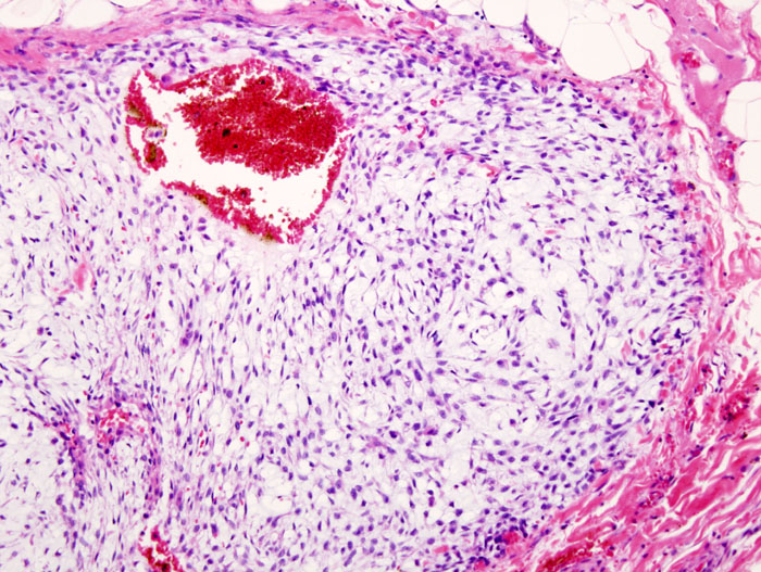 Chondrosarcoma, histology of chondrosarcoma