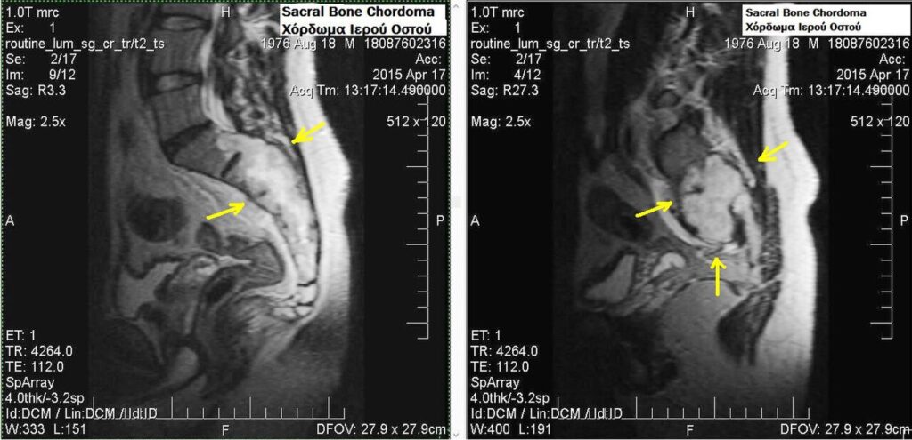 Chordoma, mri of a sacral chordoma
