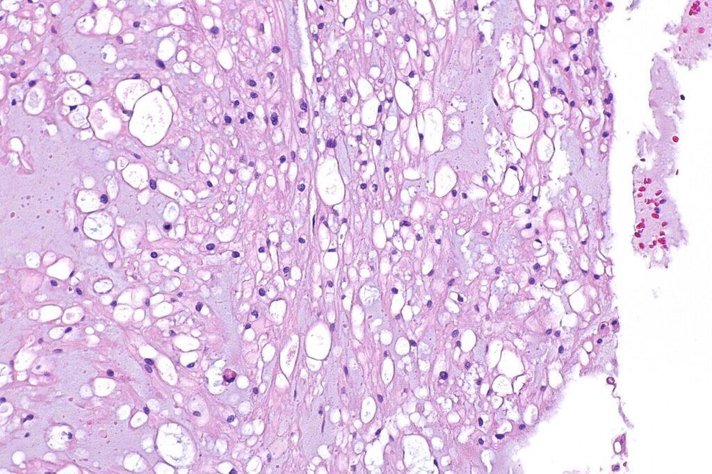 Chordoma, histology of chordoma at intermediate magnification