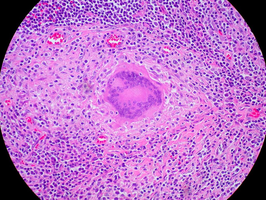 Chronic Granulomatous Disease, granuloma with a langhans giant cell