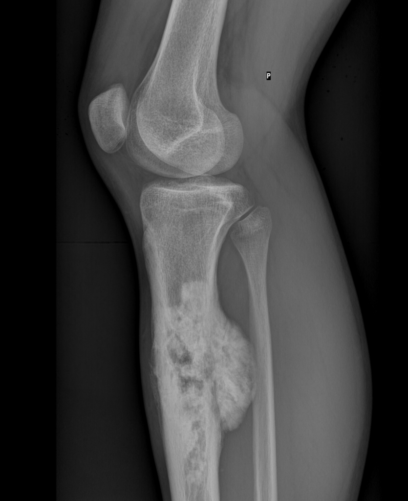 Classic Osteosarcoma, radiograph of osteosarcoma of the tibia