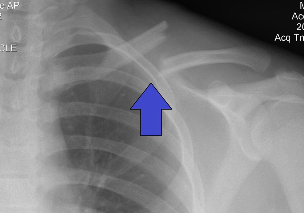 Clavicle Fractures, radiograph of a left clavicle fracture
