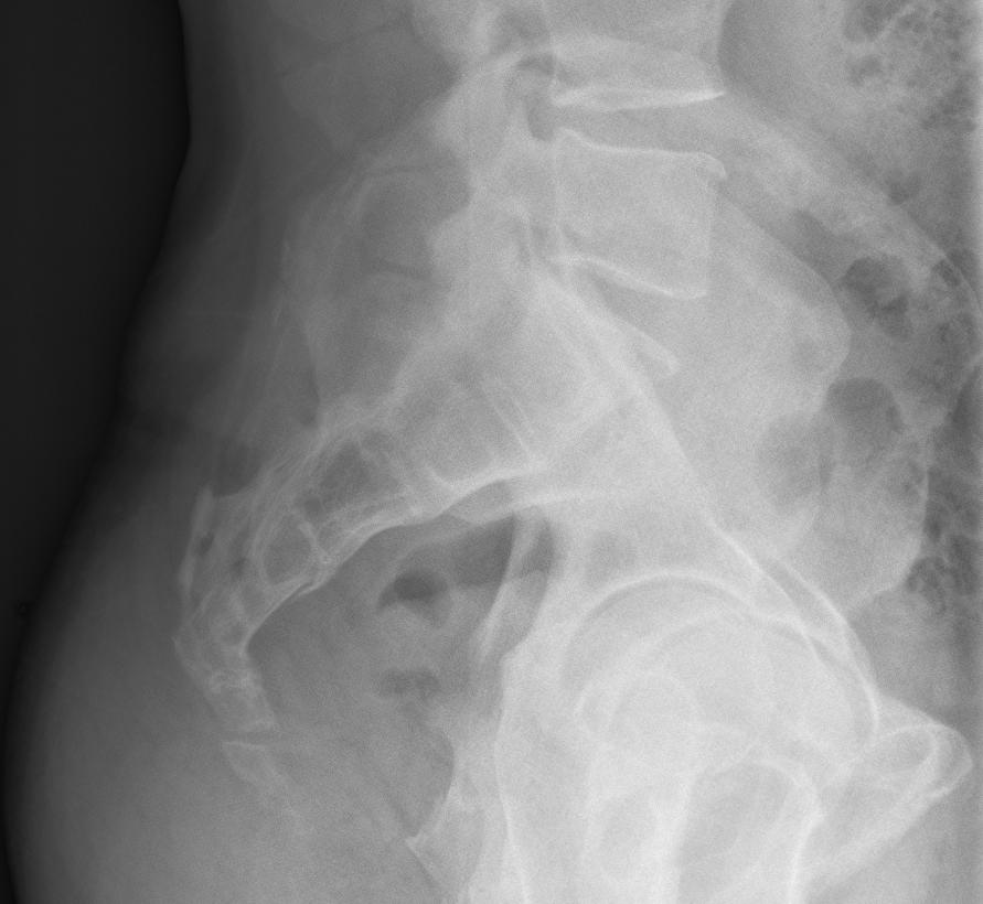Coccydynia, lateral radiograph of a coccyx fracture