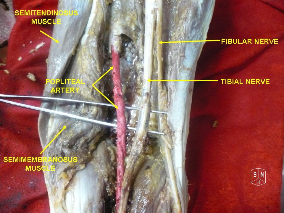 Common Peroneal Nerve, tibial and common peroneal (fibular) nerves