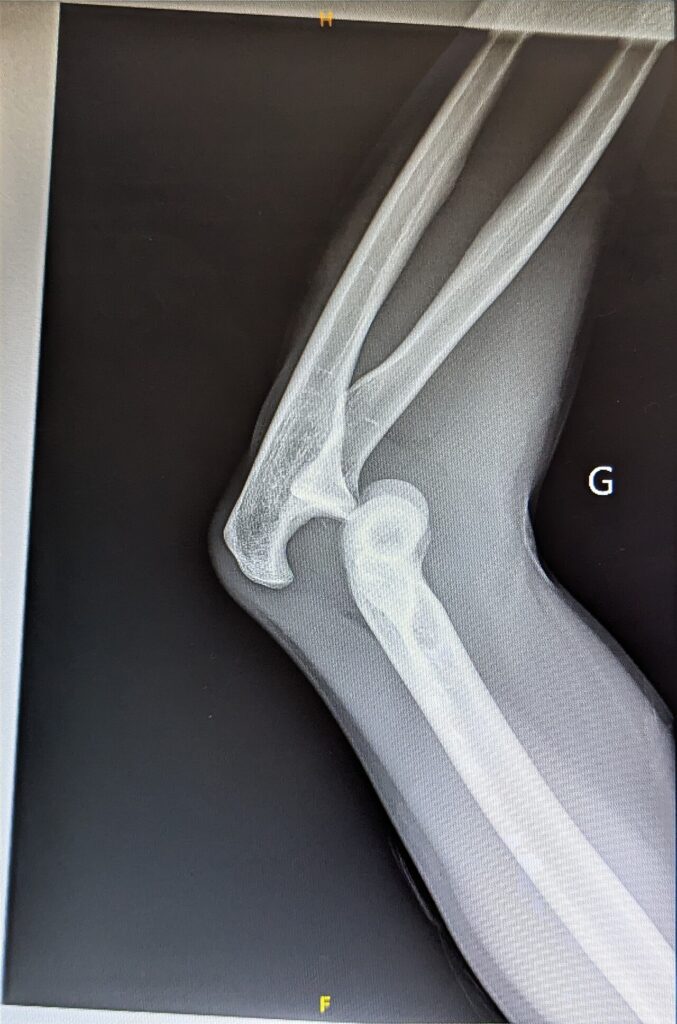 Shoulder Elbow iSAWE 18, lateral radiograph of the elbow