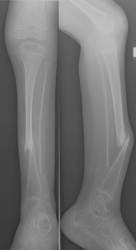 Paeds Elective iSAWE 14, radiographs of the tibia and fibula