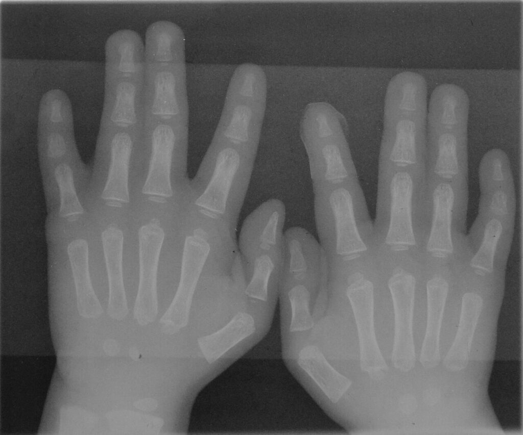 Congenital Upper Limb Deficiency, syndactyly of both hands