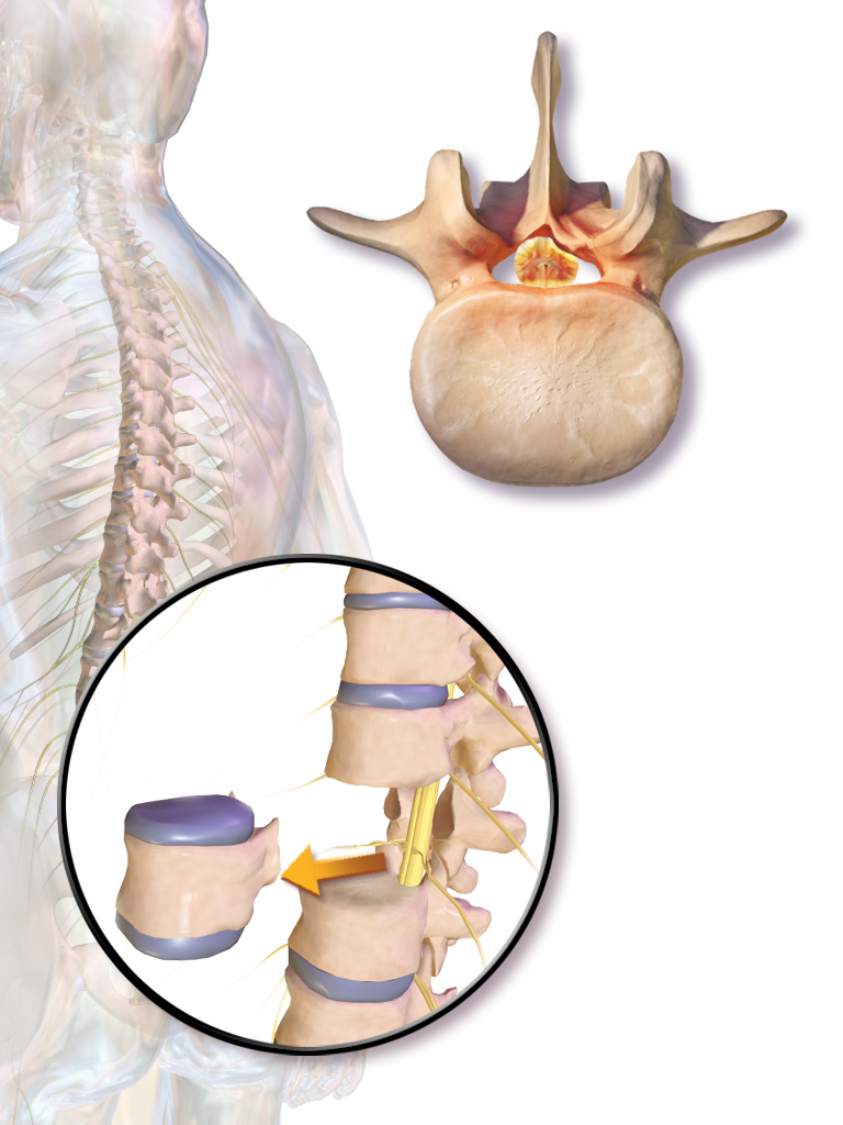 Illustration of a vertebral corpectomy, with a vertebral body and adjacent discs removed