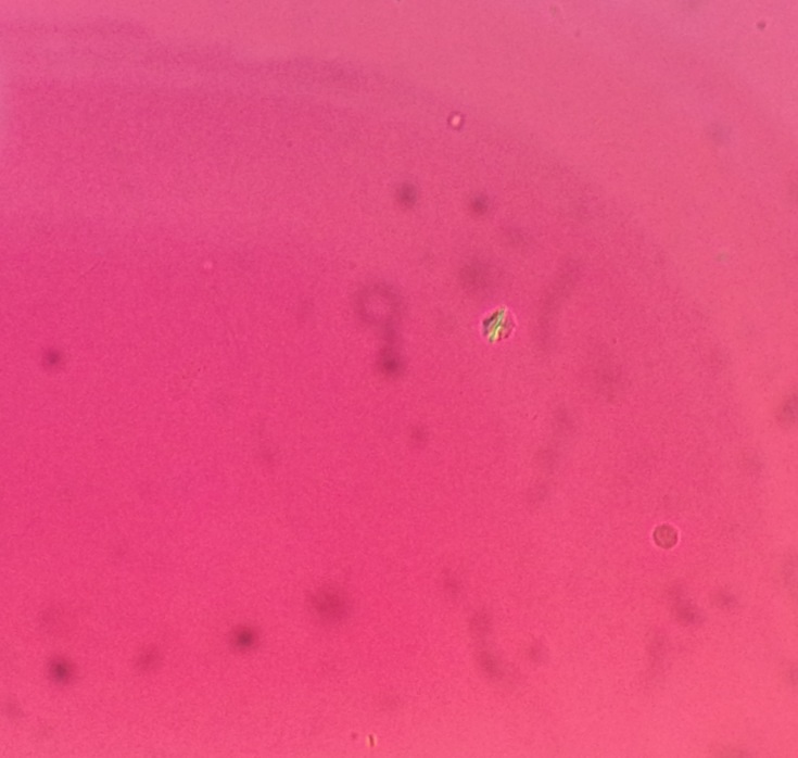 CPPD, calcium pyrophosphate crystals