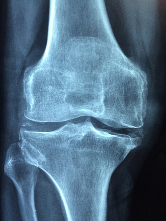 CPPD, radiograph showing chondrocalcinosis