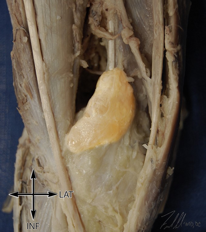 Cysts Around the Knee, dissection showing a popliteal cyst in situ