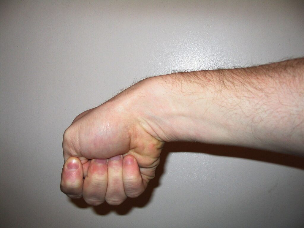 De Quervain's Syndrome, finkelstein test for de quervain tenosynovitis