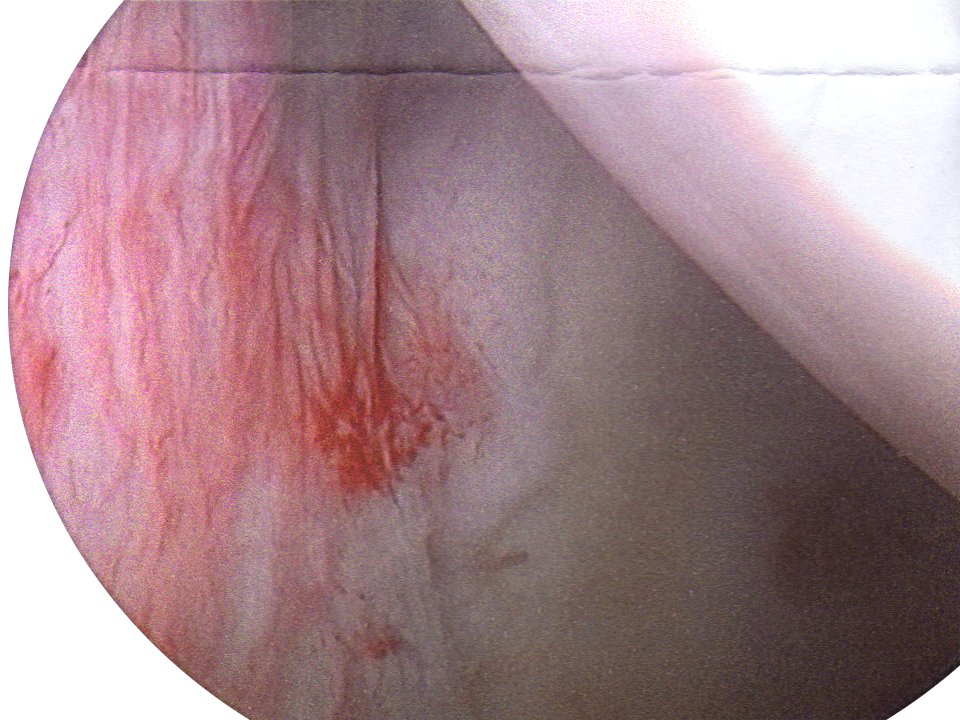 Dead Arm Syndrome, arthroscopic view of a slap lesion