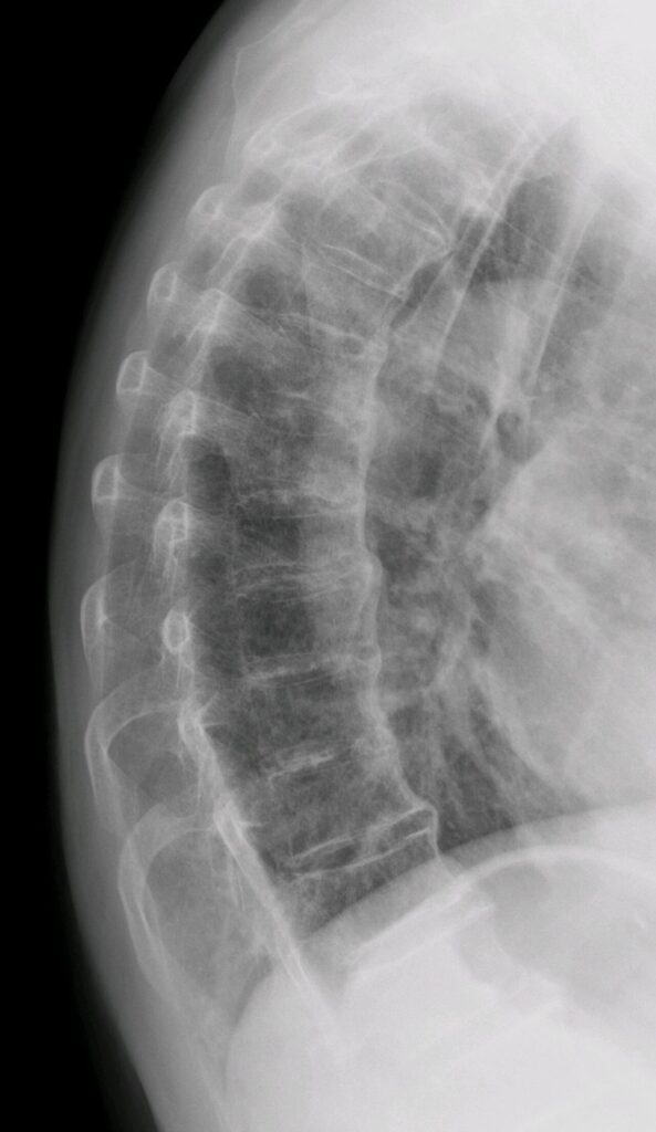 Spine iSAWE 9, lateral radiograph of the thoracic spine