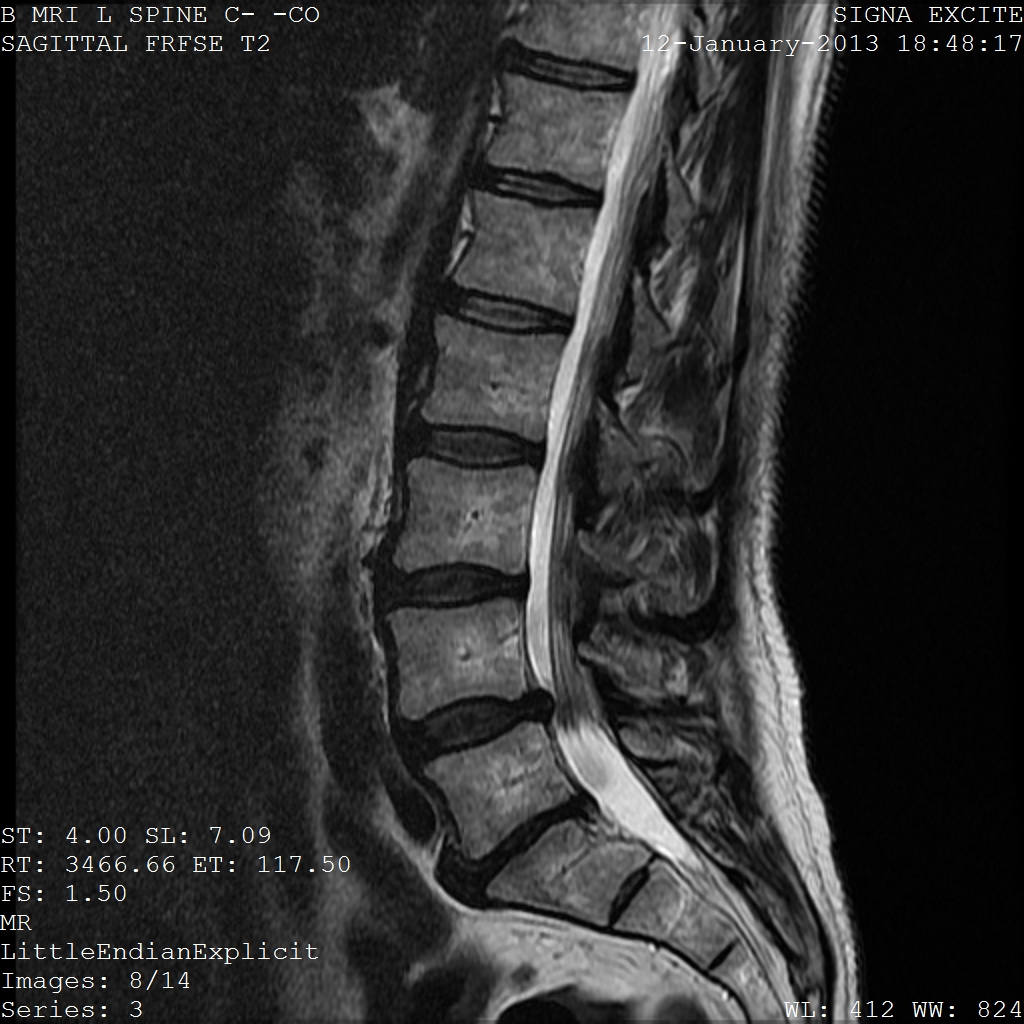 Discogenic Back Pain, sagittal t2 weighted mri of the lumbar spine