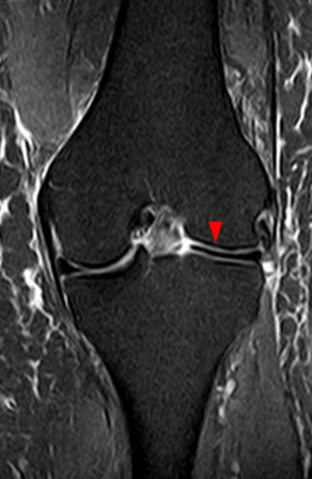 Paeds Elective iSAWE 15, coronal MRI of the knee